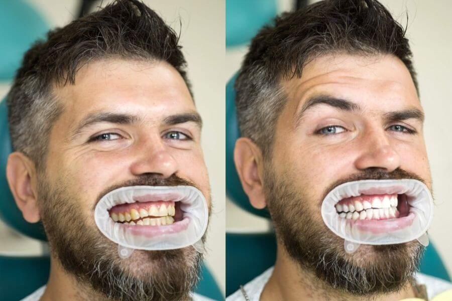Albire dinti Cluj albirea dintilor Cluj estetica dentara