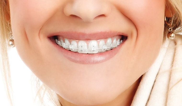 aparat dentar Cluj, aparat dentar safir Cluj