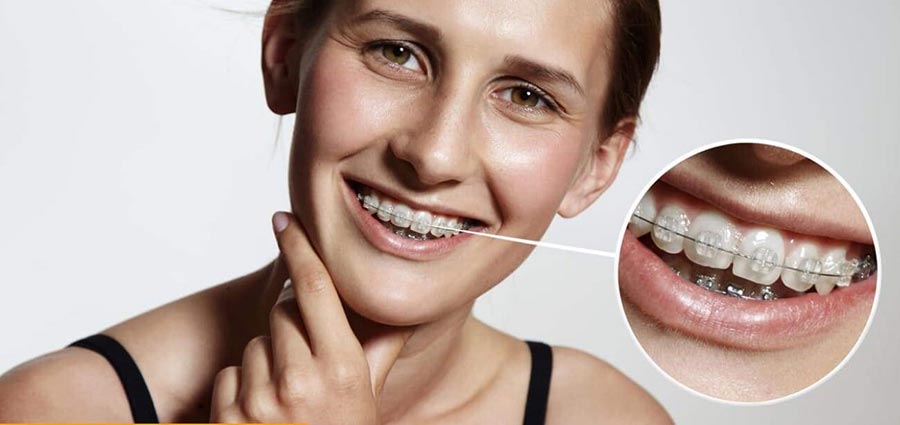 aparat dentar Cluj, aparat dentar safir Cluj