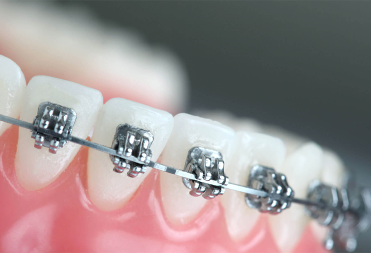 aparat dentar Cluj, aparat dentar safir Cluj