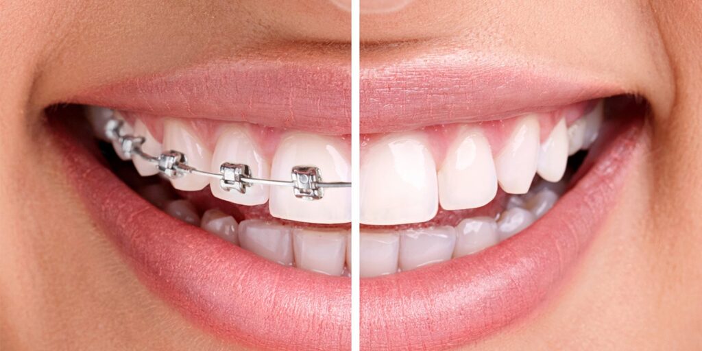 aparat dentar Cluj, aparat dentar safir Cluj