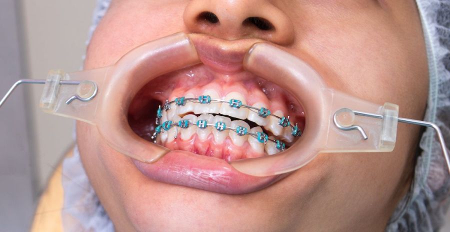 Aparat dentar Cluj-Napoca, cum alegi aparatul dentar
